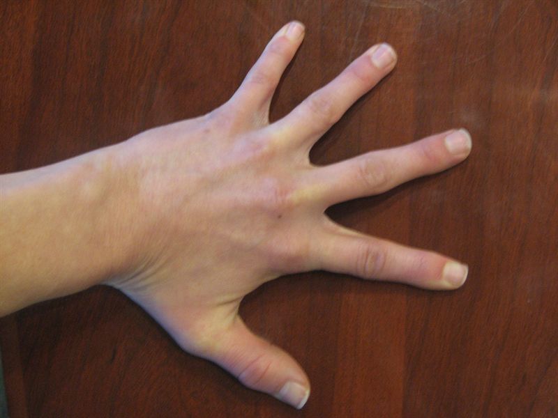 Hand weakness: Causes, symptoms, treatment, and seeking help