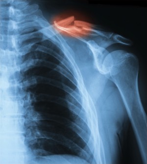 Fractured clavicle from hockey injury