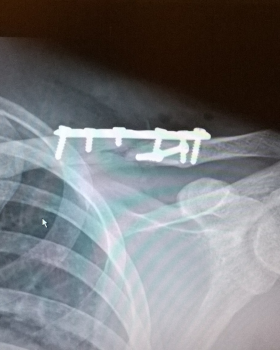 fractured clavicle image 2