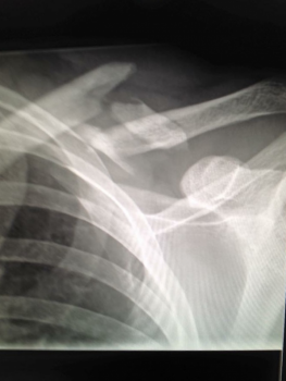 fractured clavicle image 1
