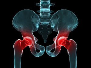 hip pain: loss of flexibility and strength