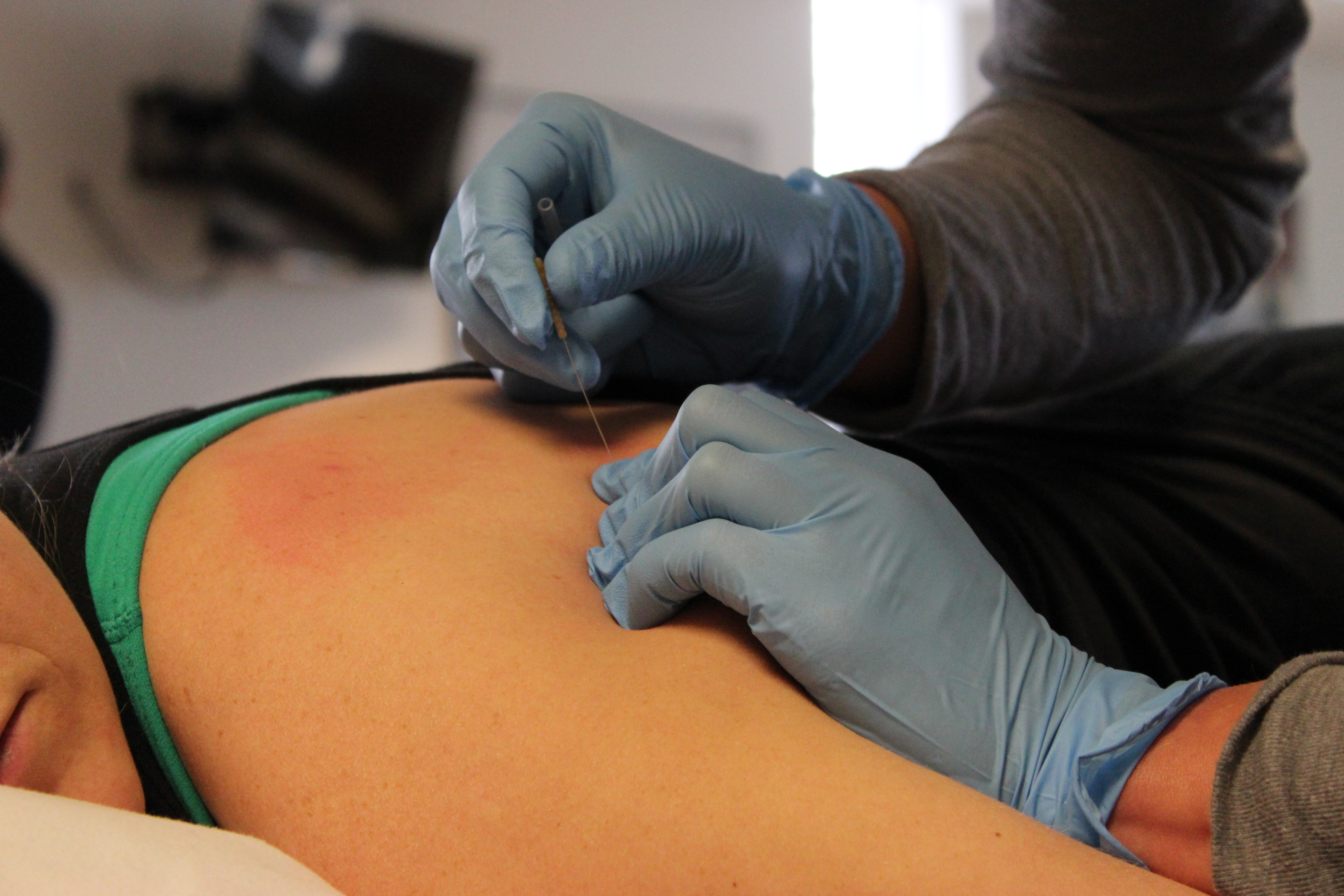 Dry Needle Therapy: How Does It Work?