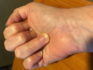 4 Common Fingertip Injuries