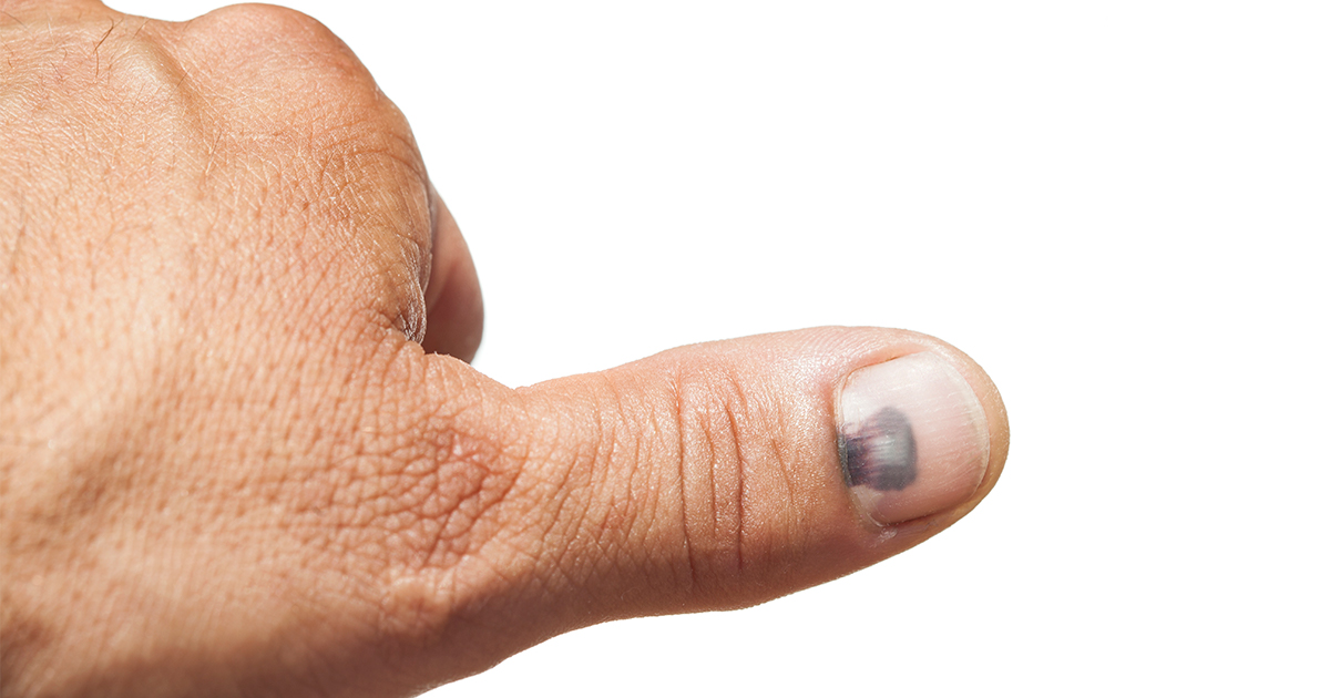 4 Common Fingertip Injuries Athletico