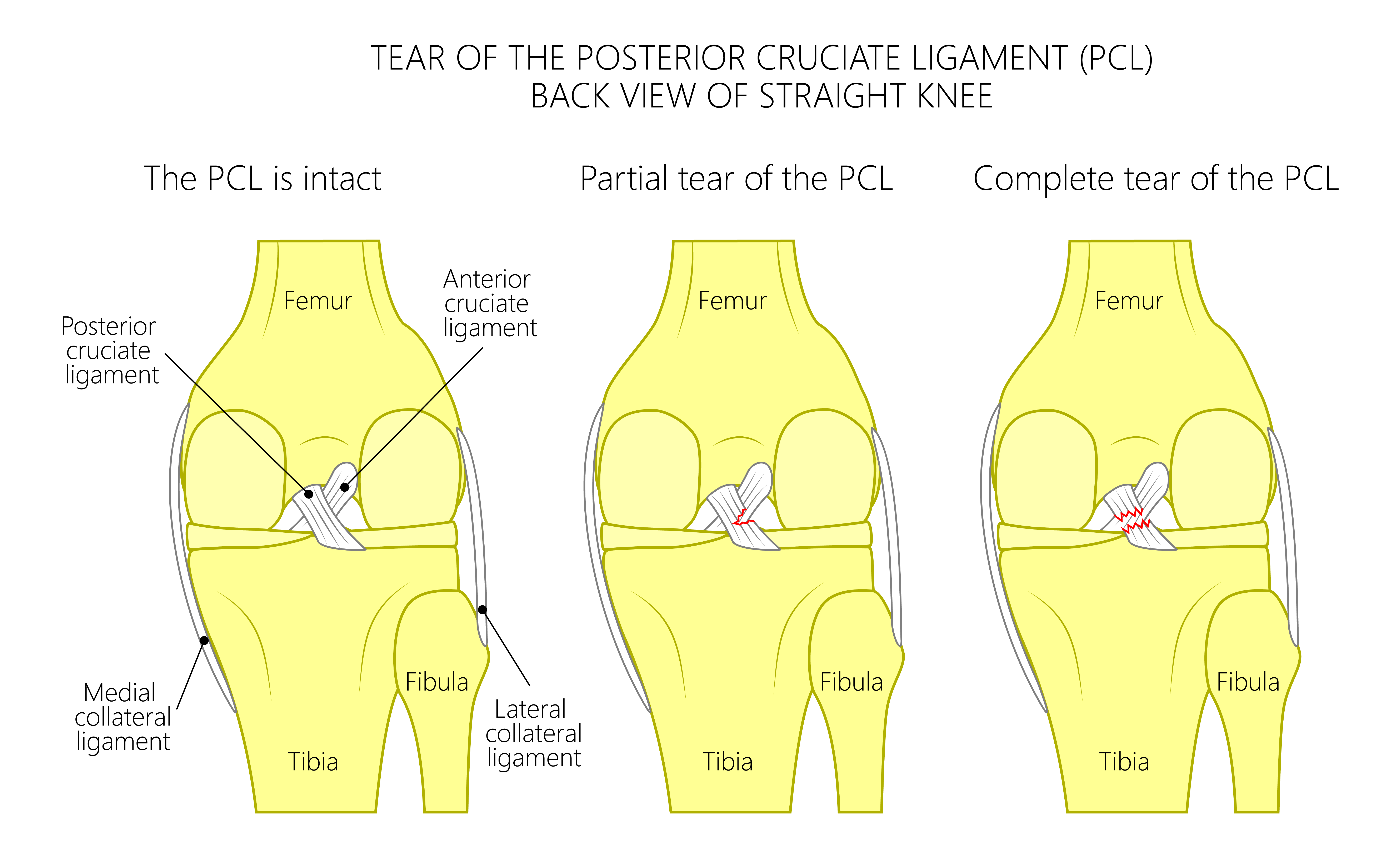 How do you tell if ACL is torn or sprained?