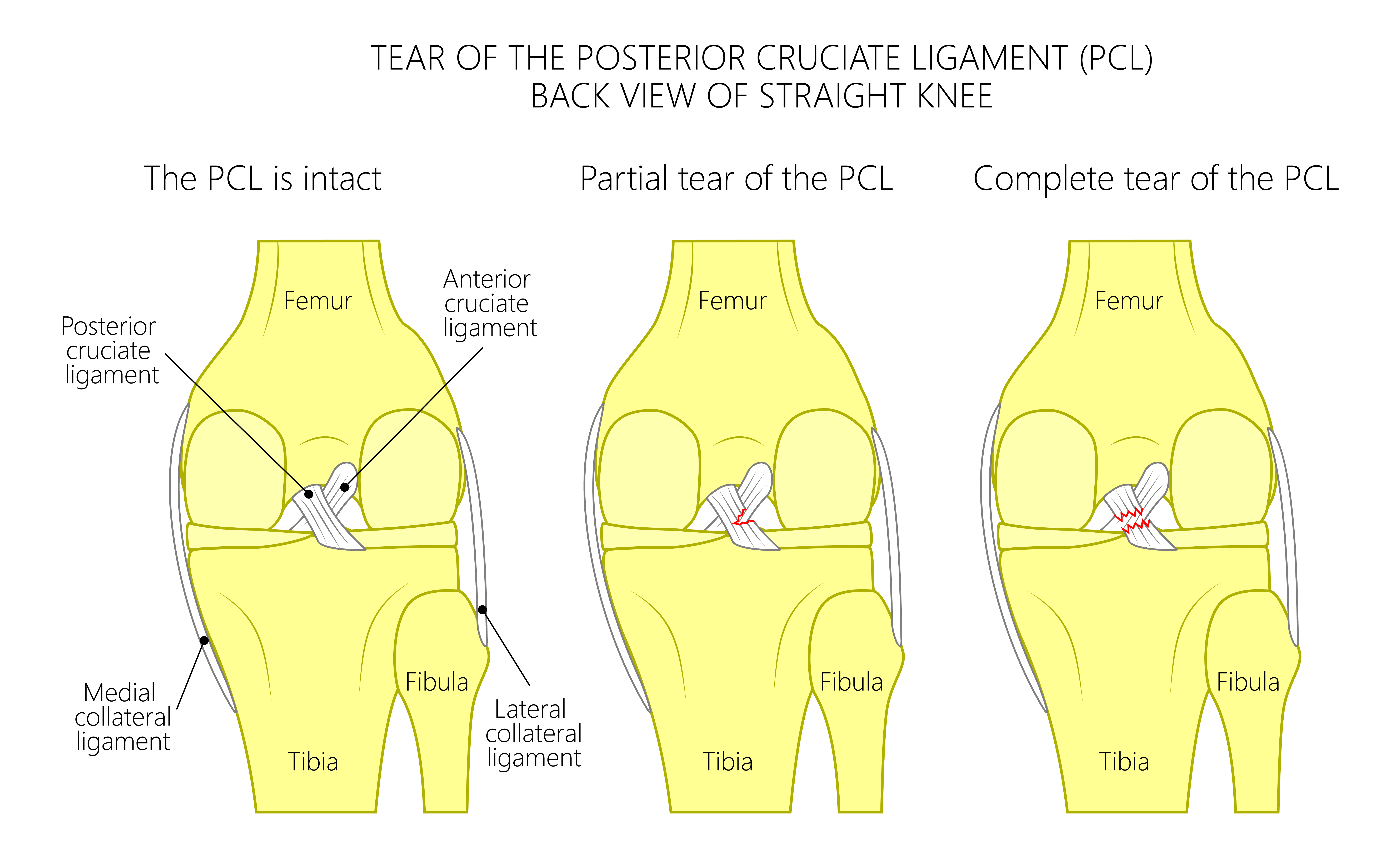 ACL Ligament Anatomy