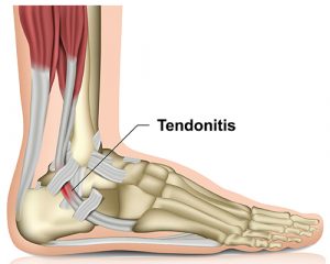 can dry needling help?