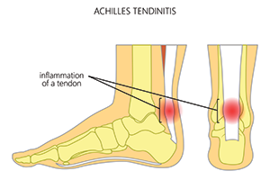 Running With Pain? You Might Have One of These Common Running Injuries