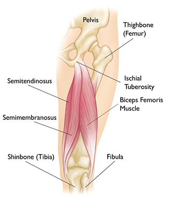 What is Ischiofemoral Impingement? 