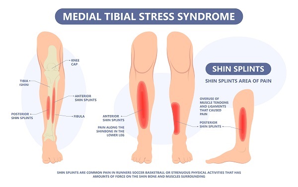 Why Do Runners Get Shin Splints