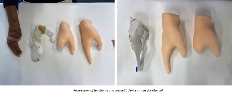 Using 3D Printers for Affordable Prosthetic Solutions