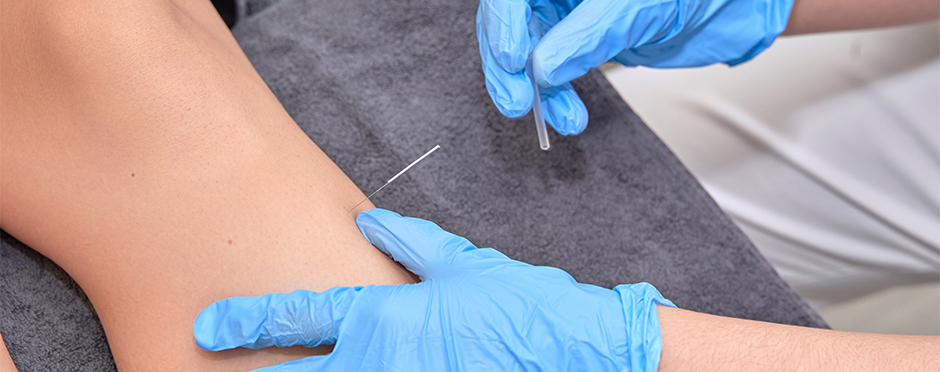 Is Dry Needling a Fad?