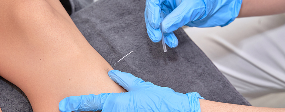 How Dry Needling Can Play A Beneficial Role In Physical Therapy